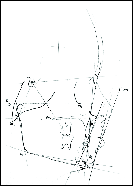 Pre-treatment cephalometric tracing