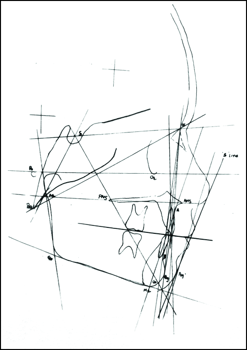 Post-treatment cephalometric tracing