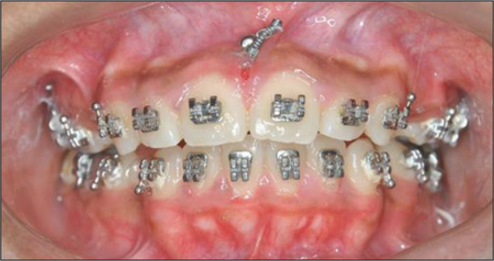 End of intrusion using mini implant at T2