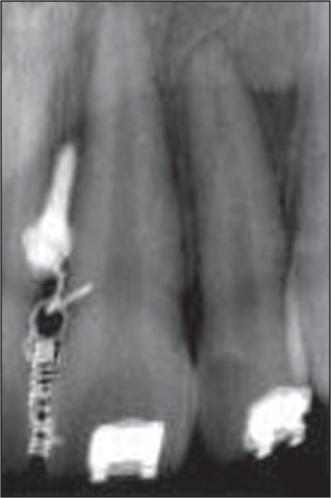 Pre-treatment radiovisiography for mini implant before intrusion at T1