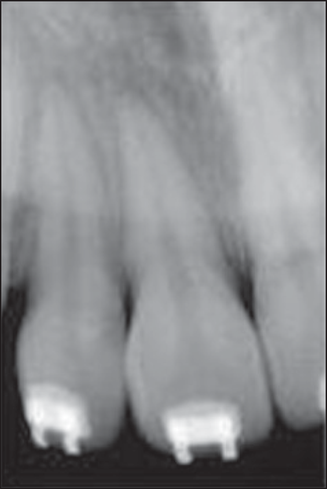 Pre-treatment radiovisiography for utility arch before intrusion at T1