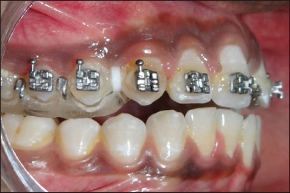 Elastomeric orthodontic separators between the canine and premolar