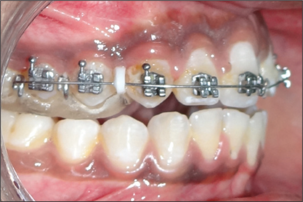 Placing nickel-titanium wire through the separators maintaining passive contact with the bracket slot of the anterior teeth