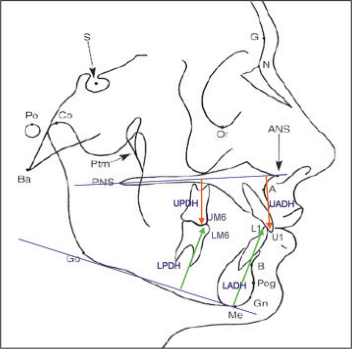 Cephalometric measurements used in the study (dentoalveolar height measurements). Upper anterior dental height (UADH): The perpendicular length of a line dropped from U1 to palatal plane, upper posterior dental height (UPDH): The perpendicular length of a line dropped from UM6 to palatal plane, UADH/UPDH: The ratio between upper anterior dento-alveolar height and upper posterior dento-alveolar height, lower anterior dental height (LADH): The perpendicular length of a line dropped from L1 to mandible plane, lower posterior dental height (LPDH): The perpendicular length of a line dropped from LM6 to mandible plane, LADH/LPDH: The ratio between lower anterior dento-alveolar height and lower posterior dento-alveolar height