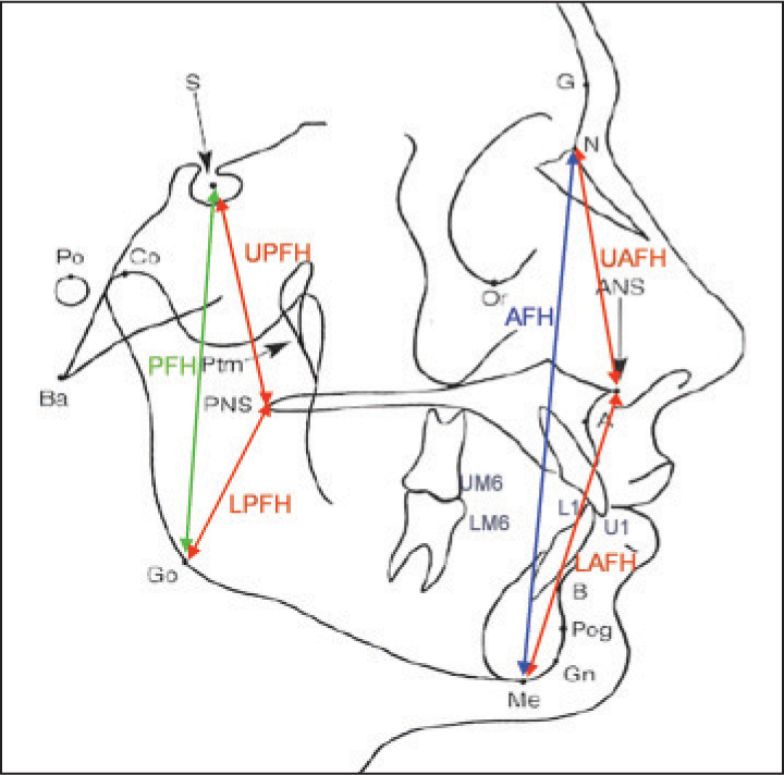 Cephalometric measurements used in the study (facial height measurements). Upper anterior facial height: The distance between N and ANS, Lower anterior facial height: The distance between ANS and Me, Anterior facial height: The distance between N and Me, Upper posterior facial height: The distance between S and PNS, Lower posterior facial height: The distance between PNS and Go, Posterior facial height: The distance between S and Go