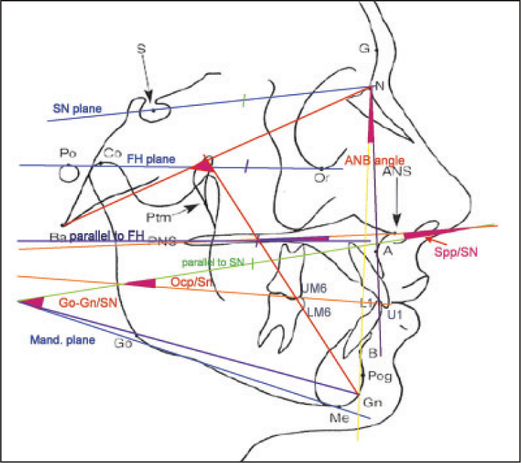 Cephalometric angular measurements used in the study Facial axis angle: The lower posterior angle formed by Ba-Na and Pt-Gn, Spp/SN: The angle between palatal plane and SN plane, Ocp/ SN: The angle between occlusal plane and SN, Go-Gn/SN: The angle between mandibular plane and SN plane, Spp/FH: The angle between palatal plane and FH, FMA: The angle between mandibular Plane and FH, SNA: The angle between SN line and NA line, SNB: The angle between SN line and NB line, ANB: The difference between SNA and SNB angle. U1-NA (degree): The angle between upper incisal axis and NA line, U1 to NA (mm): The distance from is perpendicular to NA line, L1-NB (degree): The angle between lower incisal axis and NB line, L1 to NB (mm): The distance from ii perpendicular to NB line