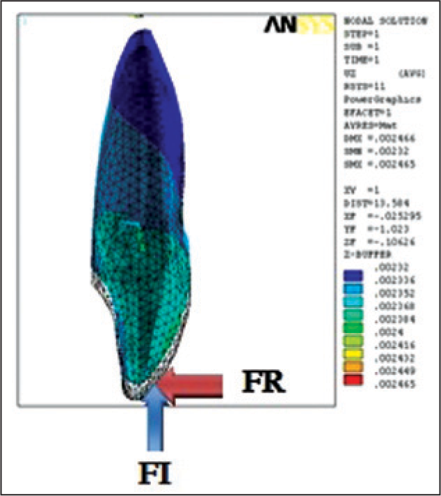 Labial force application at 4 mm with resultant intrusion