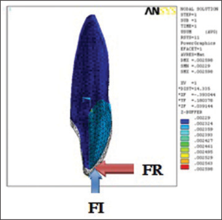 Labial force application at 6 mm with resultant intrusion