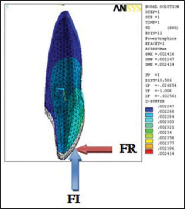 Lingual force application at 5 mm with resultant tipping