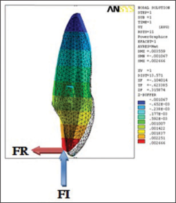 Lingual force application at 6 mm with resultant tipping