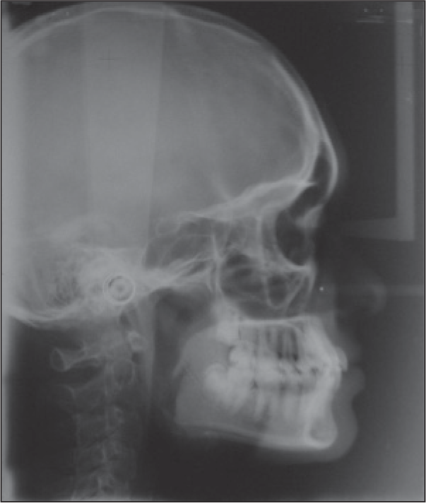 Pre-treatment lateral cephalogram