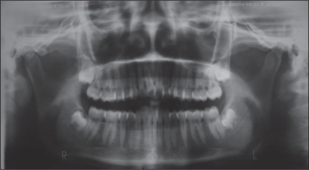 Pre-treatment OPG