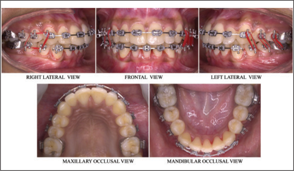 Settling of occlusion photographs