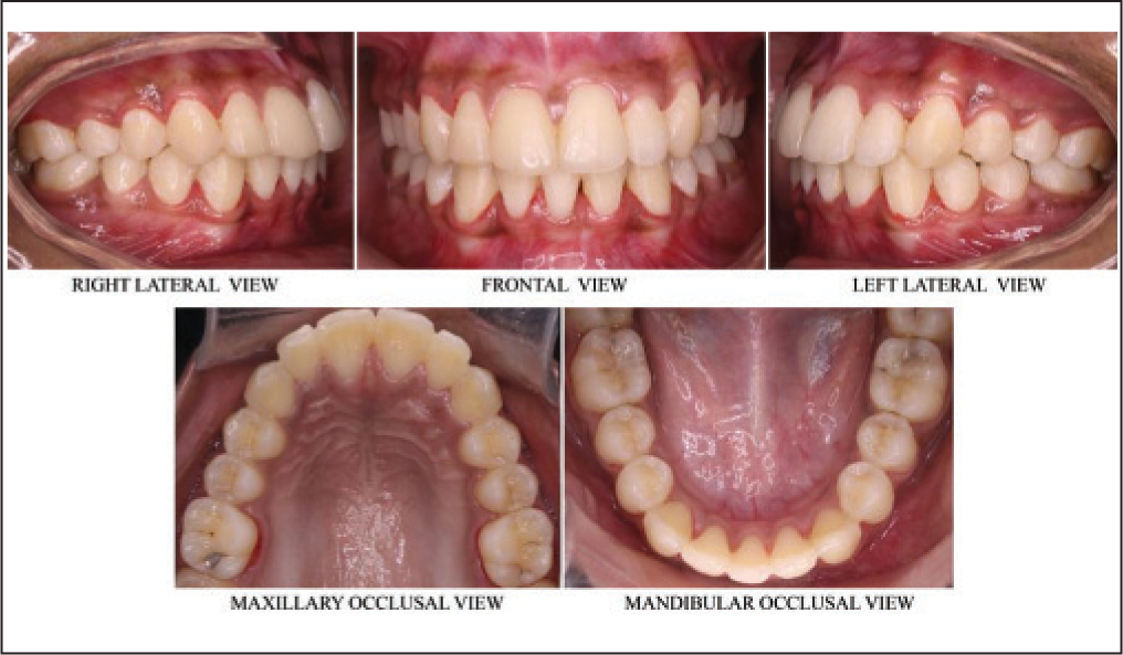 Post-treatment intra oral photographs