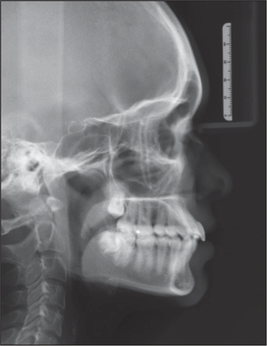 Post-treatment lateral cephalogram