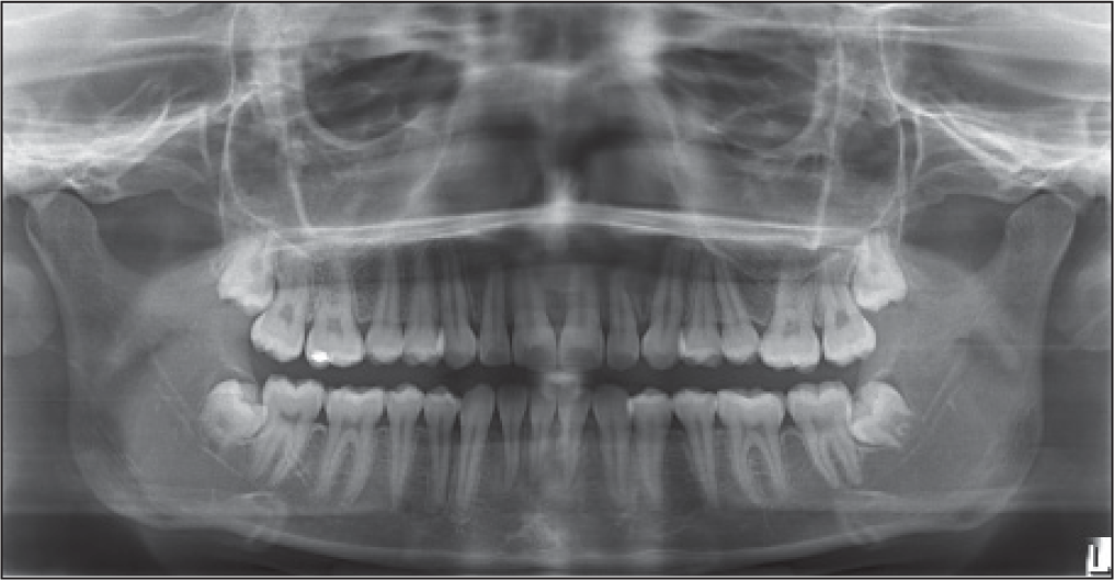 Post-treatment OPG