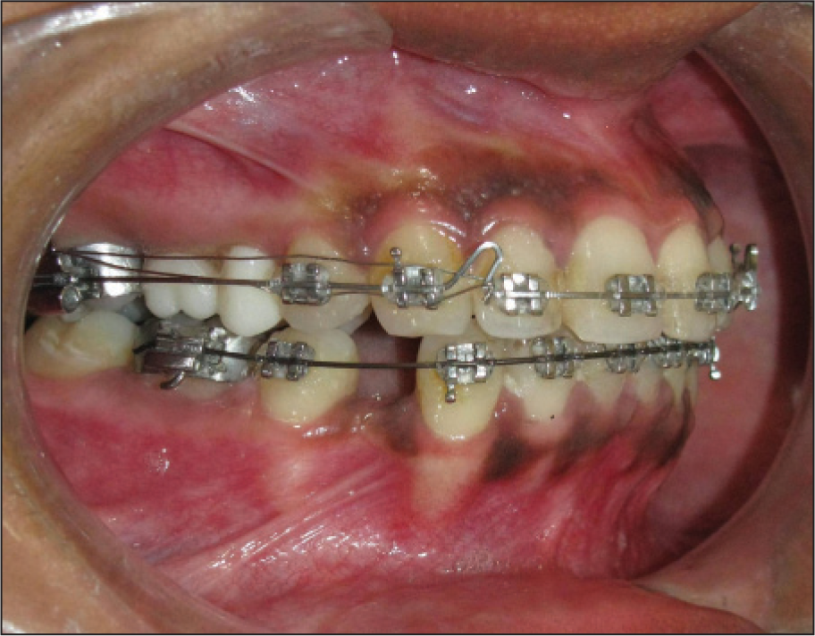 Buccal view showing removable pontic in the extraction space