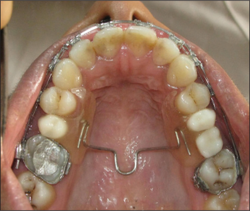 Maxillary occlusal view showing the Modified TPA-supported removable pontic