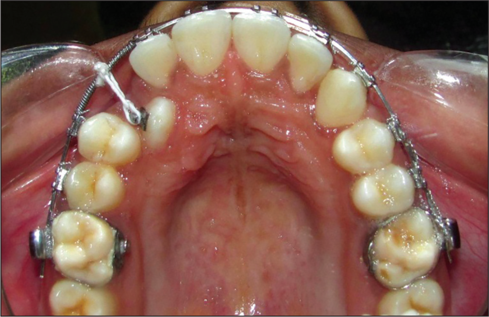 Derotation completed and alignment of impacted canine started