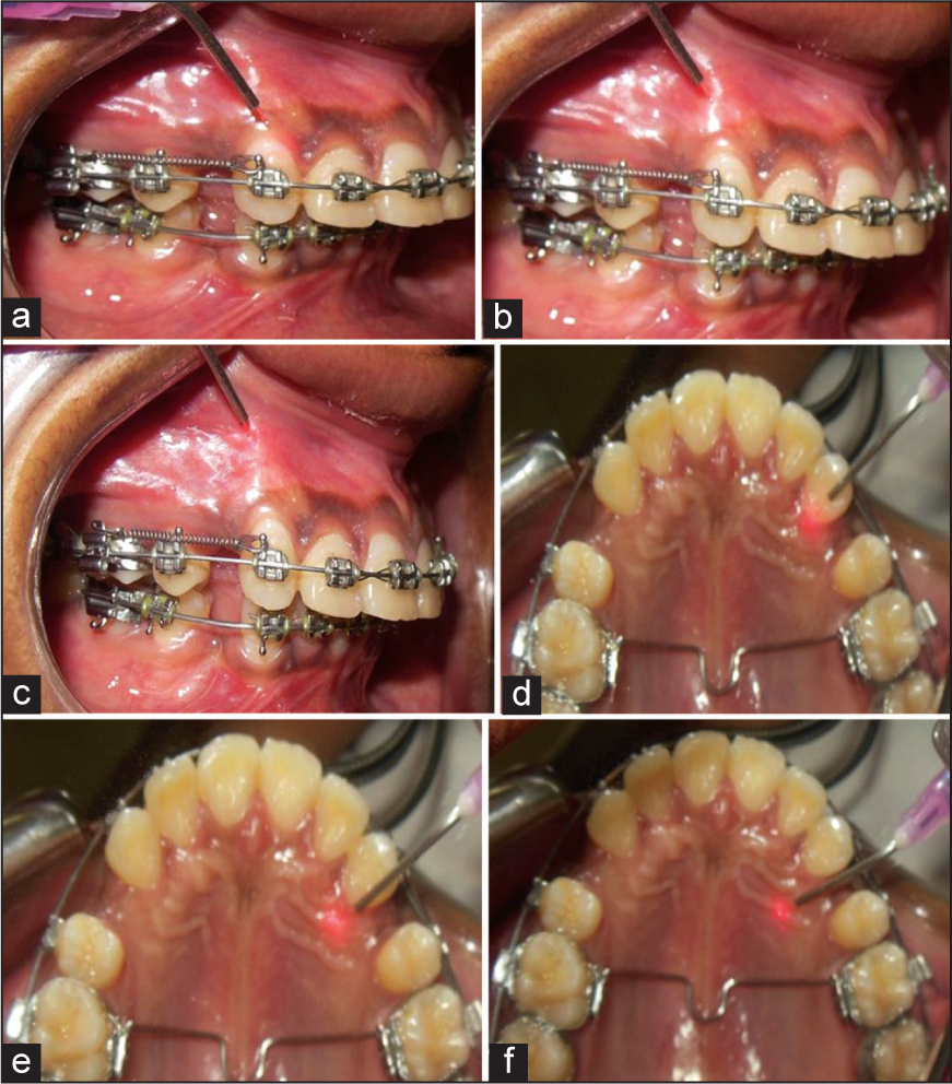 Laser therapy procedure for canine retraction on, BUCCAL. (a) Cervical 1/3rd (b) Middle 1/3rd (c) Apical 1/3rd, PALATAL (d) Cervical 1/3rd (e) Middle 1/3rd (f) Apical 1/3rd