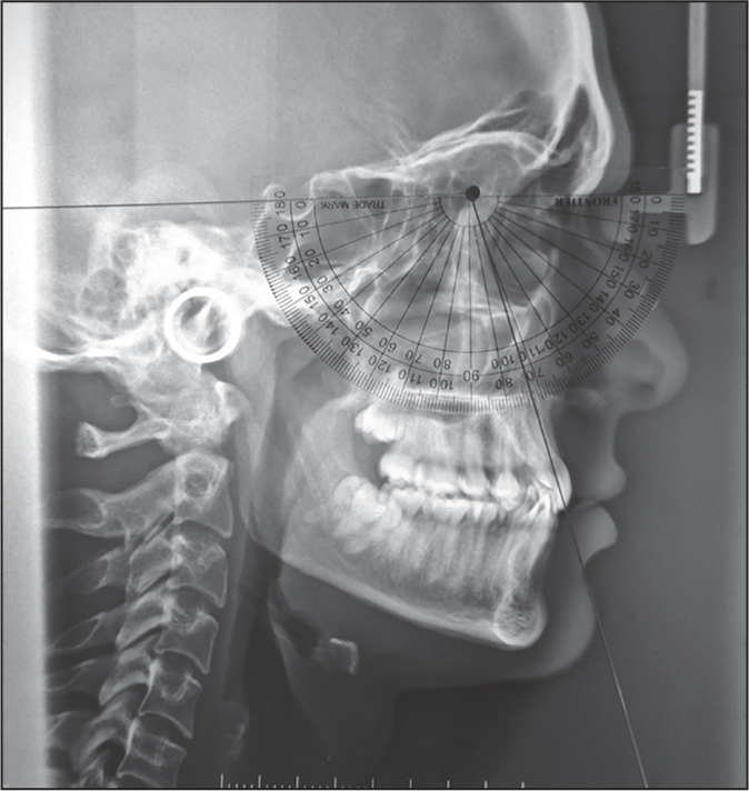 Upper incisor to SN and SNB angle