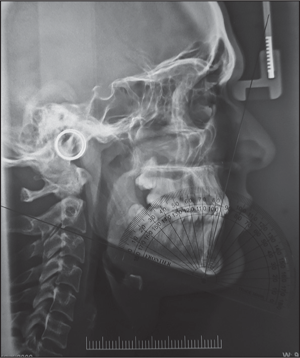 Lower incisor to mandibular plane