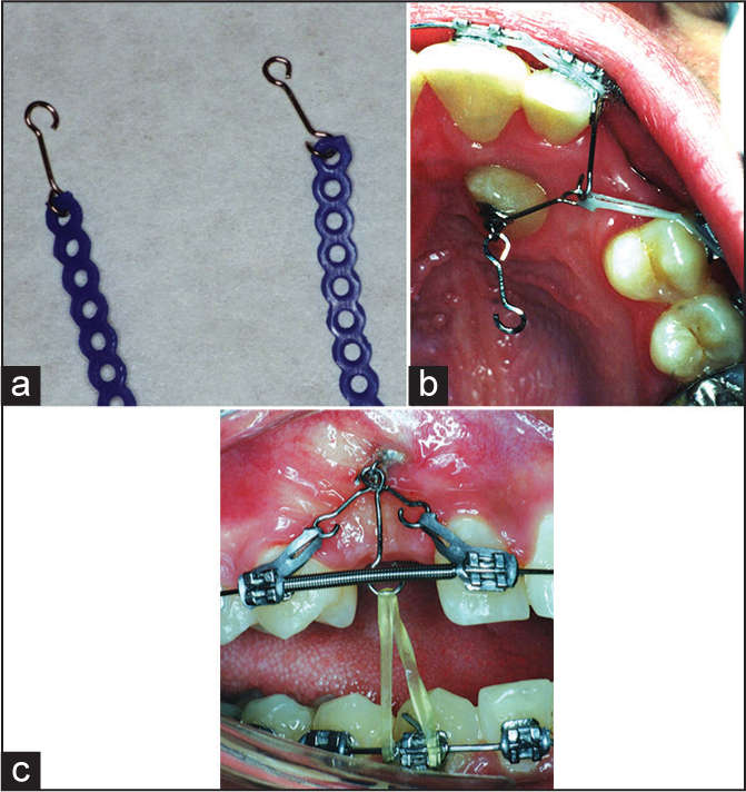 (a) Monkey hooks can be applied to a bonded loop button on a buccally or palatally impacted tooth. (b) Elastic chain, stretched from the Monkey hooks to brackets on the teeth adjacent to an impacted tooth, produce lateral and/or vertical directional forces (i.e., “sling shot” effect). (c) Intermaxillary elastics, supported by the opposite dental arch, can be attached to a third Monkey hook to produce vertical eruptive forces