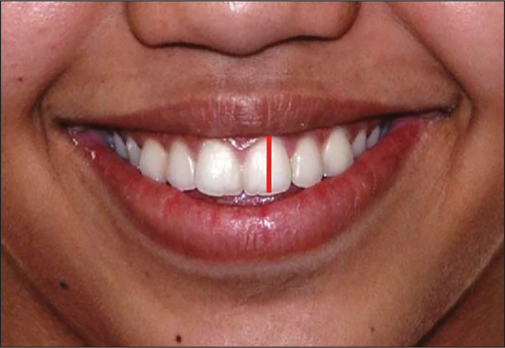Anterior height of the smile