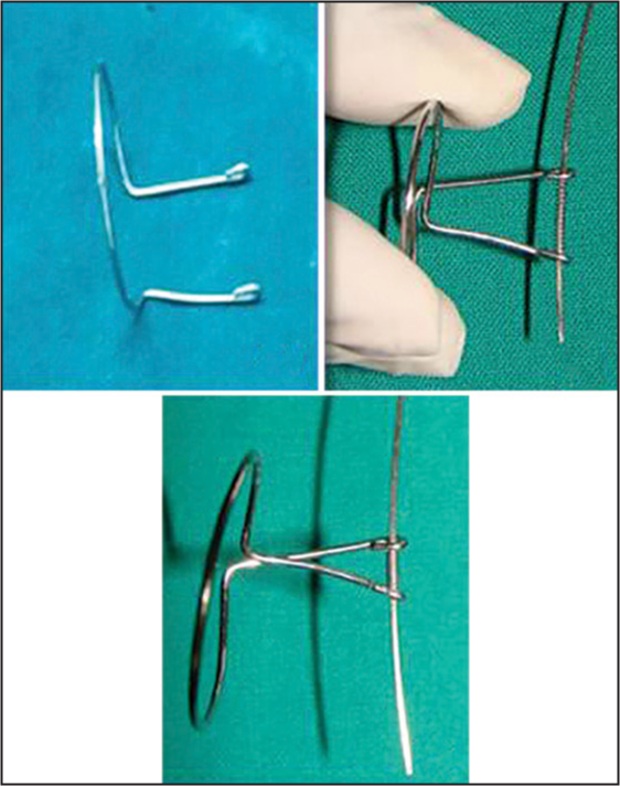 “O” device for posterior region