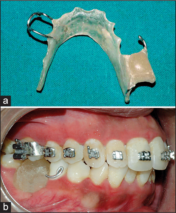 (a) Lower acrylic bite plate. (b) Intra-oral view of bite plate