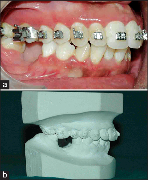 (a) Intra-oral right view depicting intruded maxillary molar. (b) Study model showing intruded maxillary molar