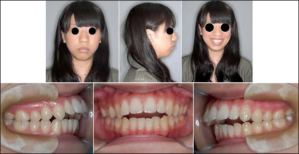 Jaw deformity patient with distally-located mandible due to progressive condylar resorption after orthodontic treatment