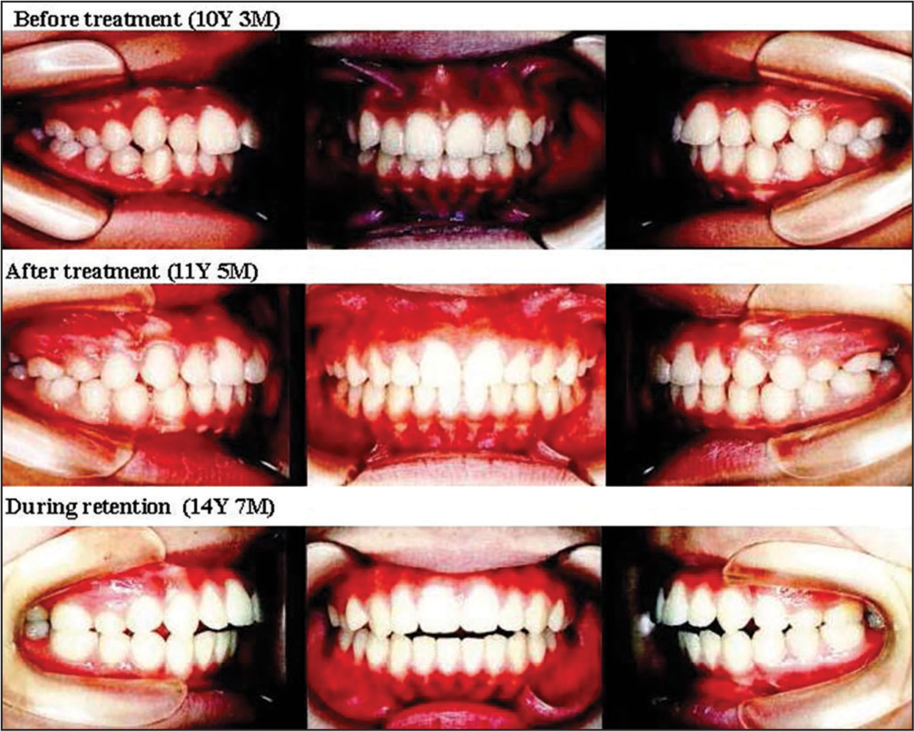 Changes in occlusion before and after orthodontic treatment and during retention