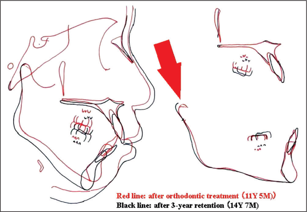 Changes in the position of mandible after orthodontic treatment due to progressive condylar resorption a red arrow indicates an existence of condylar resorption at the anterior surface of condyle during retention. An existence of condylar resorption at the anterior surface of condyle during retention