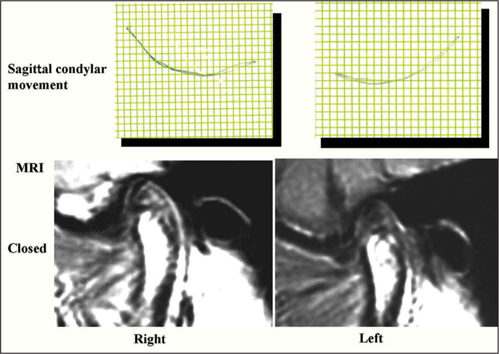 Sagittal condylar movement and magnetic resonance images after treatment (36Y 2M)