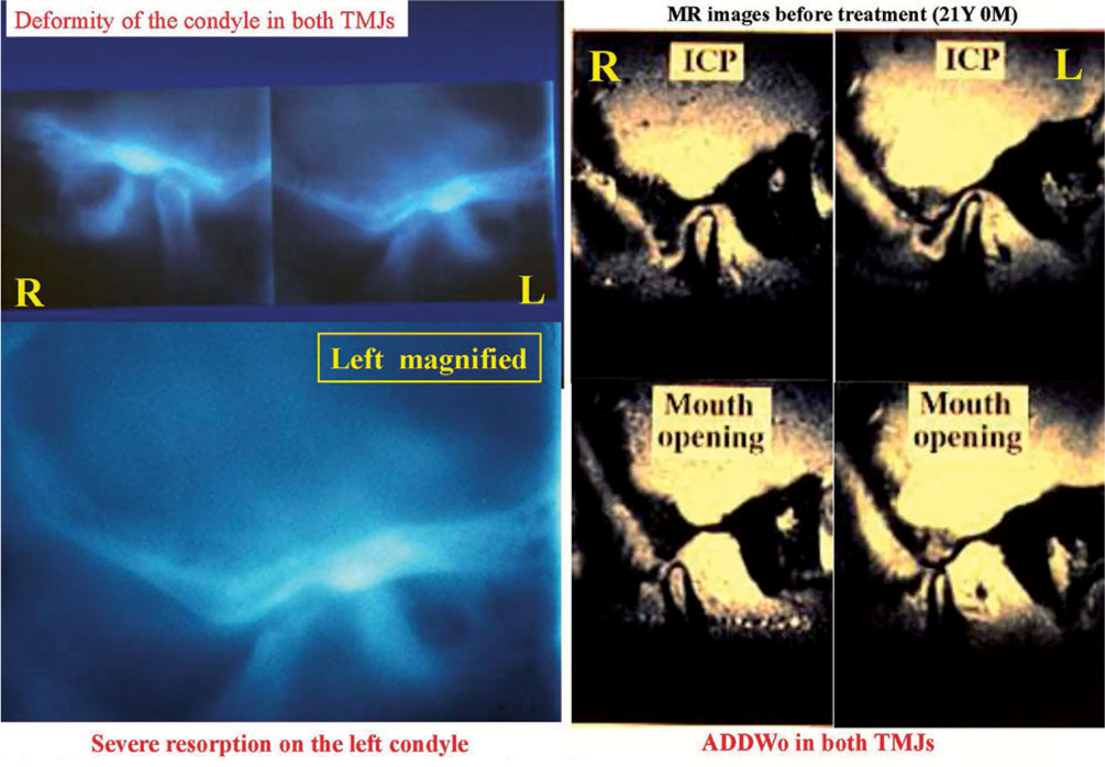 Severe resorption of left condyle on lateral tomograms (left) and anterior displacement of articular disk without reduction on magnetic resonance images (right)