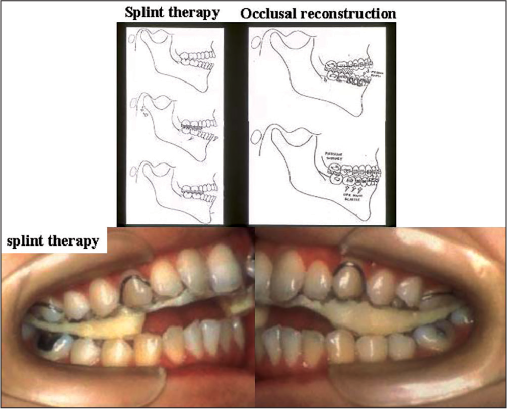 A schematic illustration of splint therapy to eliminate temporomanidular joint pain and limited mouth opening and the following occlusal reconstruction with orthodontic approach