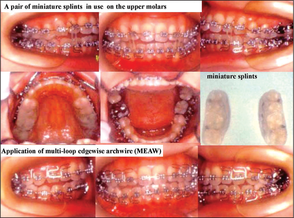 Occlusal reconstruction with orthodontic treatment and splint in use
