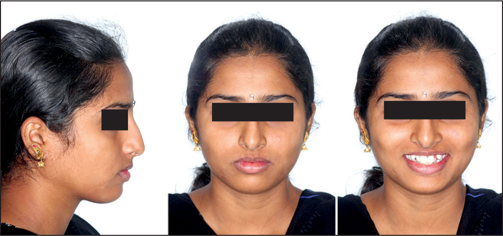 Pre-treatment extraoral photographs showing mild convex profile and competent lips