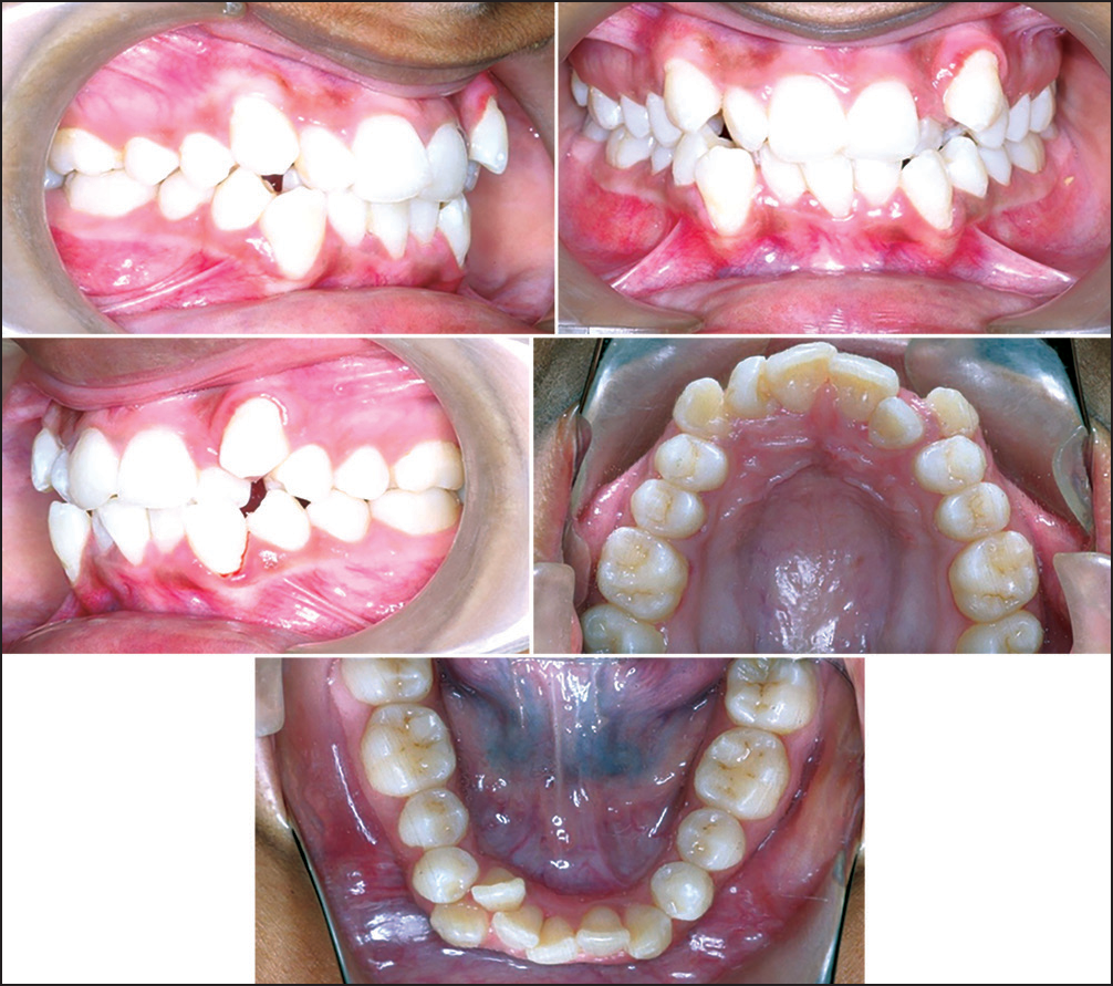 Pre-treatment intraoral photographs showing Class I molar relation bilaterally, overjet of 1 mm, upper and lower anterior crowding and crossbite in relation to 12 and 43 and in relation to 22 and 33