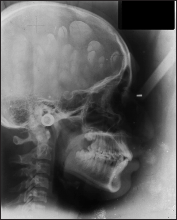 Pre-treatment lateral cephalogram showing orthognathic maxilla and orthognathic mandible with Class I skeletal pattern and average growth pattern