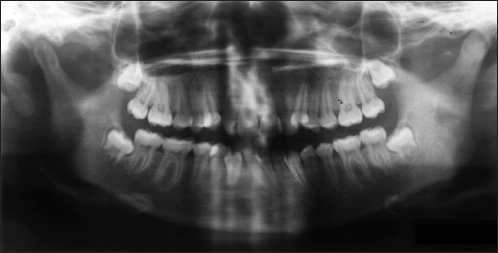 Pre-treatment orthopantamogram