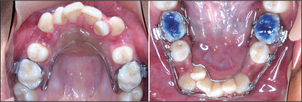 Anchorage reinforced using soldered Nance palatal arch in the upper arch and lingual arch in the lower arch