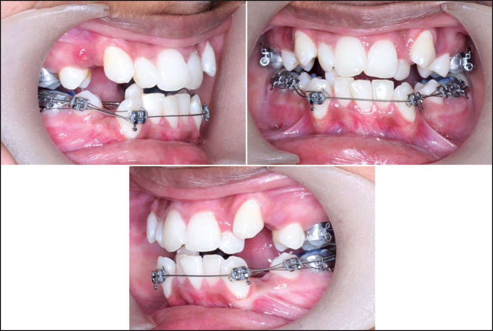 Initial 0.0175” coaxial wire with lacebacks to retract lower canines