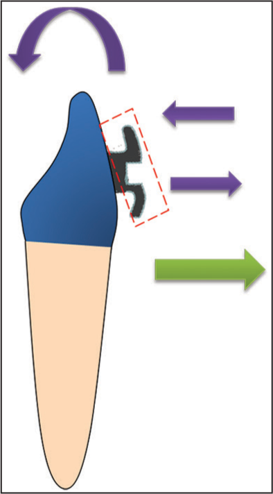 Biomechanics of action of MAA on lower incisor. Purple arrows indicate the couple force generated and the resultant torque. Green arrow indicates the labial force generated on tying the MAA to the lingually placed tooth