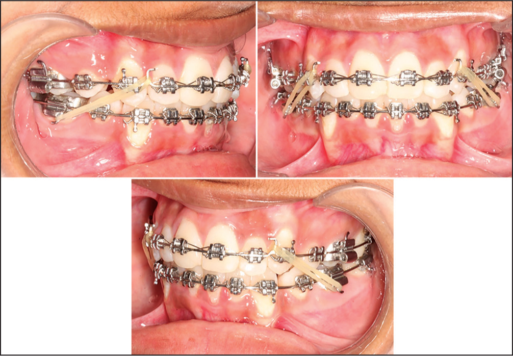 Second molars bonded, aligned and upper 0.019 × 0.025 SS with spee and lower 0.017 × 0.025 SS with reverse spee with class 2 elastics