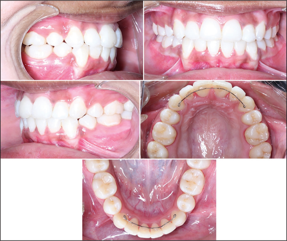 Post-treatment intraoral photographs