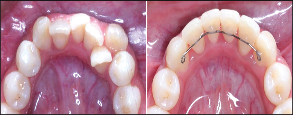 Comparison of lower incisors before and after treatment