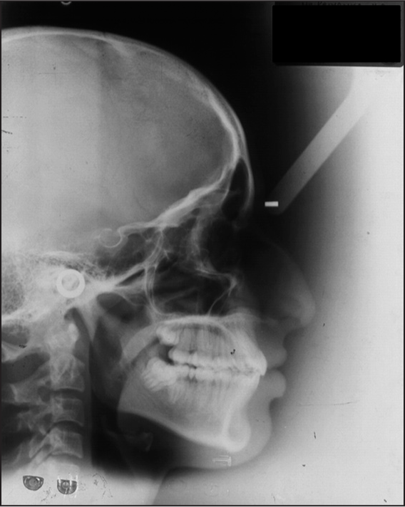 Post-treatment lateral cephalogram