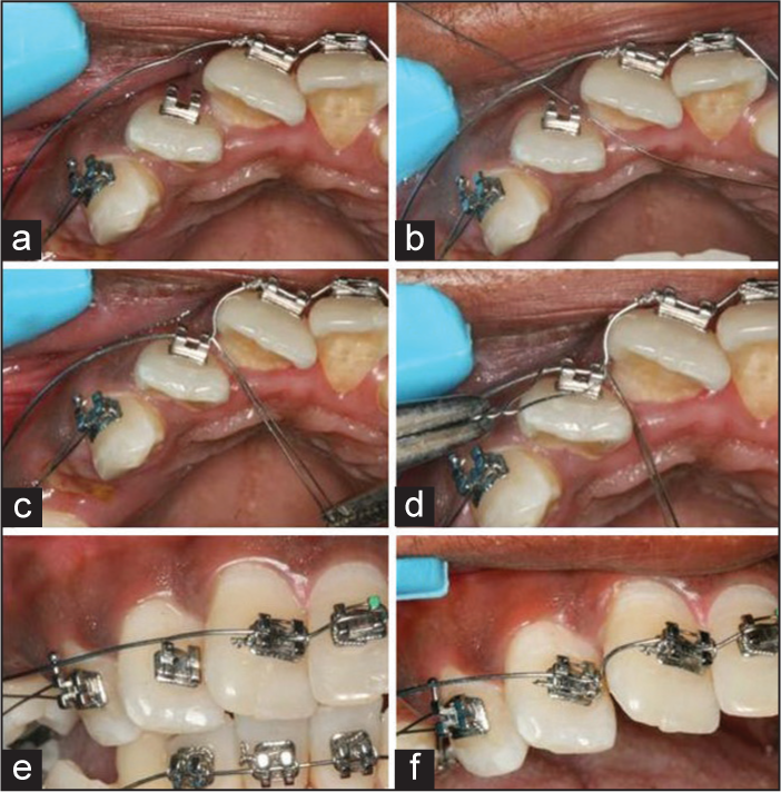 0.009″ stainless steel ligature wire is used to engage the archwire in the bracket slot and is ligated into the bracket of a rotated lateral incisor. (a-d) Occlusal view. (e and f) Frontal view